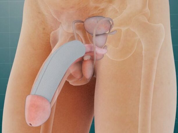 Penis käyttöönoton jälkeen erityinen implantti ihon alle